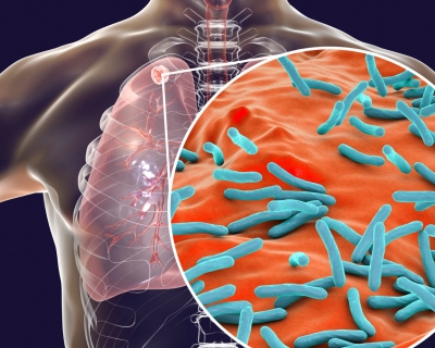 Computer rendering of human torso with mass in its lung overlaid with close-up of Mycobacterium tuberculosis bacteria.