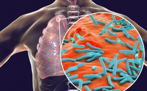 Computer rendering of human torso with mass in its lung overlaid with close-up of Mycobacterium tuberculosis bacteria.